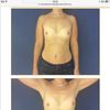 265 oder 285 ml für Brustvergrößerung von 75A-B auf volles B?