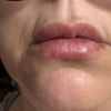 Senkrechte tiefe Oberlippenfalten nach Filler