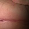 Heilung und Nachkontrolle 15 Tage nach Brustvergrößerung mit 395cc Polytech anat. Implis UBM