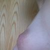Form, Profil und Größe bei Brustvergrößerung