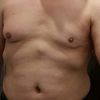 Größere Brust und Knoten unter der Brustwarze mit 46 Jahren