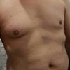 Größere Brust und Knoten unter der Brustwarze mit 46 Jahren