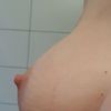 Ist das normal oder eine Komplikation?