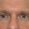 Augen und Brauen Asymmetrie nach Oberlidstraffung
