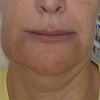Hyaluron/geschwollenes Kinn nach 3 monaten
