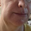 Hyaluron/geschwollenes Kinn nach 3 monaten