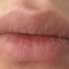 Menge und Haltbarkeit von Juvederm Ultra Smile für Lippenvergrößerung