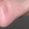 Harte Nasenspitze und Höcker nach Nasenkorrektur