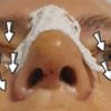 Nasenlöcher unterschiedlich durch Gips