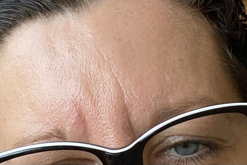 Ausgeprägte Zornesfalte, kann man tiefe Falten mit Botox und Hyaluron glätten?