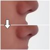 Philtrum Profil ( Bereich zwischen Mund und Nase) aufspritzen?