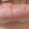 Narbengewebe in der Lippe nach Unfall