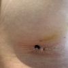 Narben nach 14 Tagen post OP