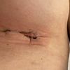 Narben nach 14 Tagen post OP