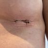Narben nach 14 Tagen post OP