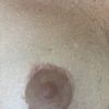 Extreme Narbenbildung am oberen Rand der Brustwarzen