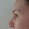 Nasenkorrektur - Unebener Nasenrücken nach OP