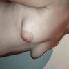 Gewebeexpander Erfahrung