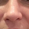 Ungleiche Nasenflügel und geschwollen in der Spitze 8 Wochen Postop