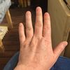 Behandlung von alt aussehenden Händen wegen Neurodermitis mit 22