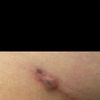 Blase auf Narbe nach Brust OP
