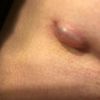 Blase auf Narbe nach Brust OP