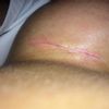 Wundheilung 6 Wochen post Brustvergrößerung