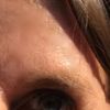 Oberlidstraffung, Botox oder Kanthoplastik?
