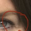 Oberlidstraffung, Botox oder Kanthoplastik?