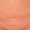 Dellen 2 Monate nach Fettabsaugung am Bauch