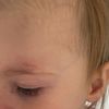 Kinder Narbe nach Platzwunde über der Augenbraue, wie Pflege ich Narbe richtig?