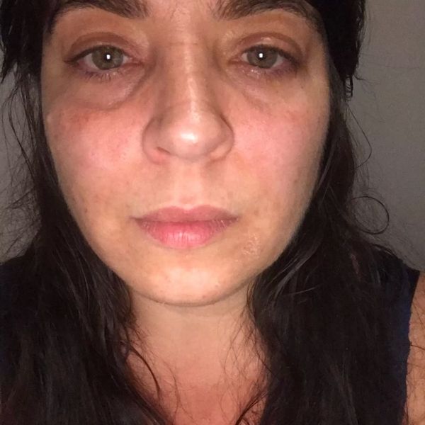 Hyaluron bei Asymmetrie im Gesicht?