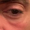 4 Tage nach Hyaluroneinspritzung unter dem Auge Schwellungen / Knubbel