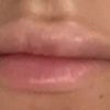 Ungleichmässige lippen 0.5ml 