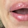 Hilfe! Mobilisiert sich die Hyaluronsäure. Knubbelige & Wulstige Lippen nach Injektionen