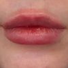 Zu schmale Lippen für Hyaluron?