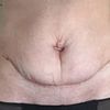 Nachkorrektur wegen überschüssiger Haut 4 Wochen nach kleiner Bauchdeckenstraffung?