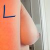 11 wochen post op Brüste ungleich 
