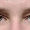 Oberlider nach Augenlidstraffung unterschiedlich
