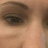 Schwellung unter dem Auge 2 Jahre nach Hyaluron gegen Augenringe
