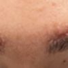 Augenbrauenlifting-OP / Suche Meinungen und Rat
