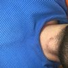 Narbe Hals nach Kehlkopffraktur auffällig? Bitte um Hilfe