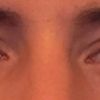 Asymmetrische Augen korrigieren
