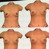 Unsicherheit wegen Implantatwahl vor Brustvergrößerung von 70/75 A auf B, 160 cm, 52 kg