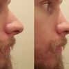 Nasenscheidewandbegradigung mit Nasenverkleinerung kombinieren?