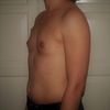 Implantatgröße bei Brustvergrößerung, 165 cm und 55 kg, 220 ml bis 295 ml?
