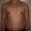 Implantatgröße bei Brustvergrößerung, 165 cm und 55 kg, 220 ml bis 295 ml?