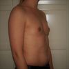 Implantatgröße bei Brustvergrößerung, 165 cm und 55 kg, 220 ml bis 295 ml?