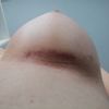 Asymmetrie und Druck auf die Brust Falte 3 Monate post op 