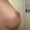 Double Boubble Effekt? 3 Monate post OP